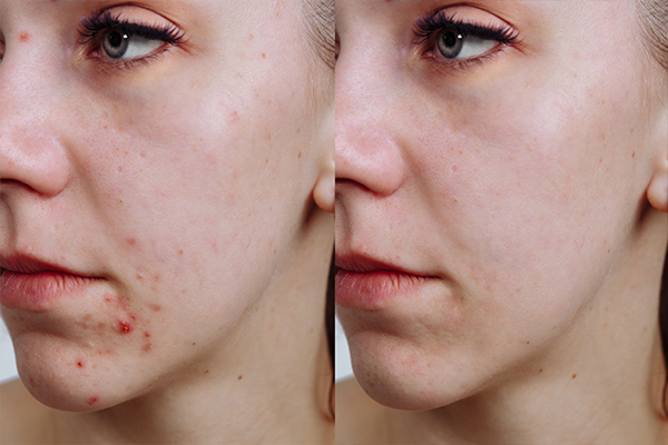 Acne Help for Adults and Teens - Blog | Metrin